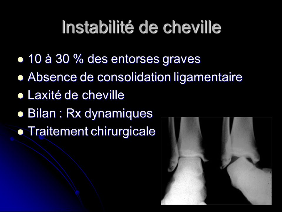 Entorse et luxation cheville ppt video online t l charger